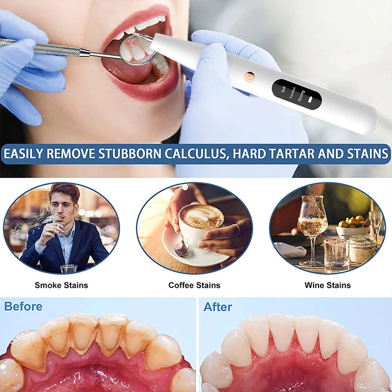 Ultrasonic Dental Calculus Scaler for Teeth Electric Tartar Calculus Remover Plaque Stains Remover Dental Stone Removal with Led