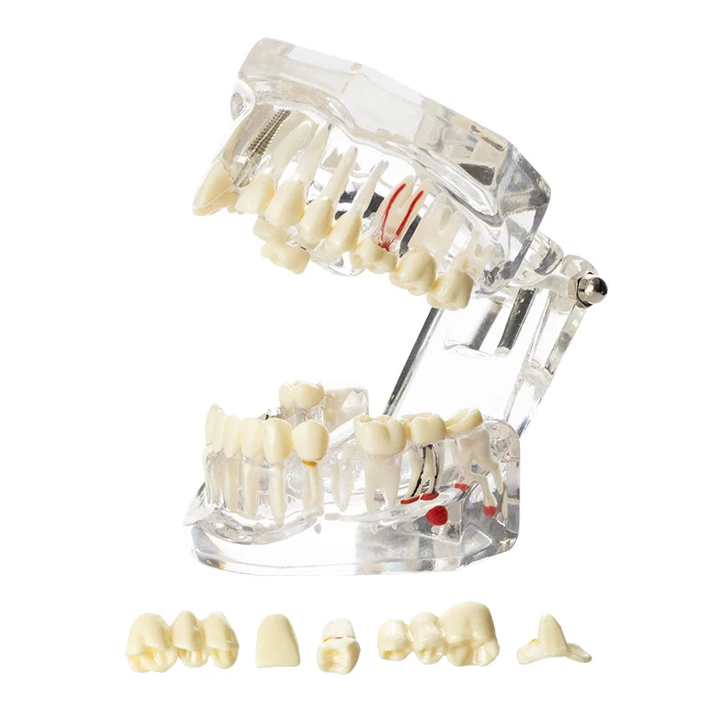 Dental Model Teeth Implant Restoration Bridge Teaching Study Medical Science Disease Dentist Dentistry Products Dental Gift