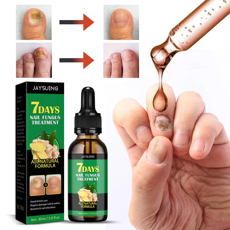 1-5Pcs Nail Fungal Treatment Device 7 Days Repair Oil Foot Toe Essence Anti Infection Paronychia Ginger Onychomycosis Gel Care