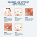 Beauty Salon Special Remove Acne Fat Particle Needle Tool Ultra-fine Cell Pimple Blackhead Whitehead Clip Black Dot Pore Cleaner