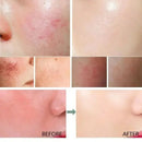 Facial Redness Repair Cream Sensitive Skin Dryness Moisturizer Hydrating Sooth Serum Lotion  Removal Rosacea Skin Care Ointments