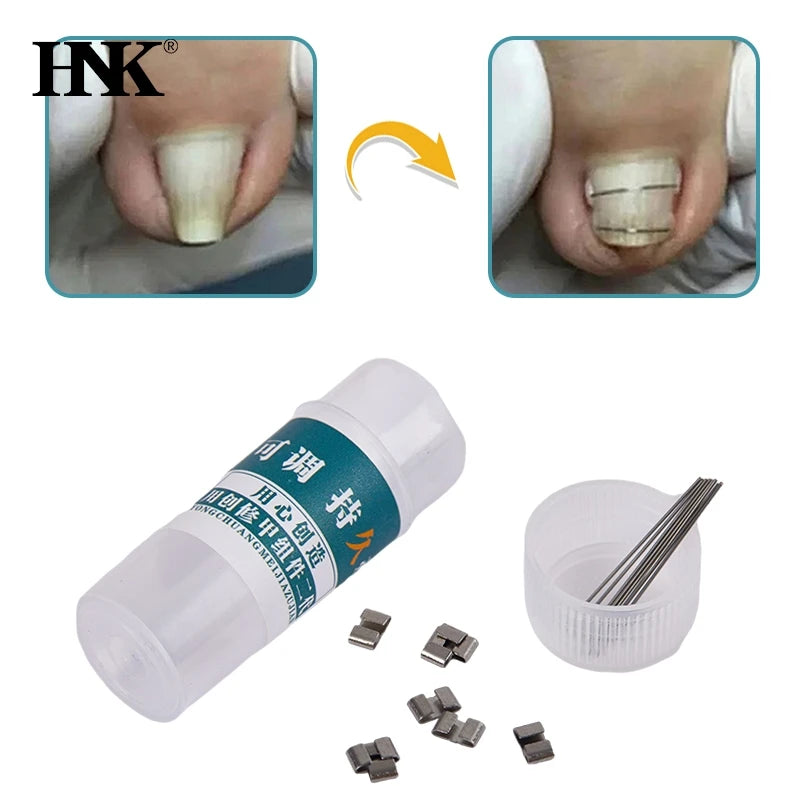 Ingrown Toenail Corrector Tools Pedicure Recover Embed Toe Nail Treatment Professional Ingrown Toenail Straightening Clip Brace