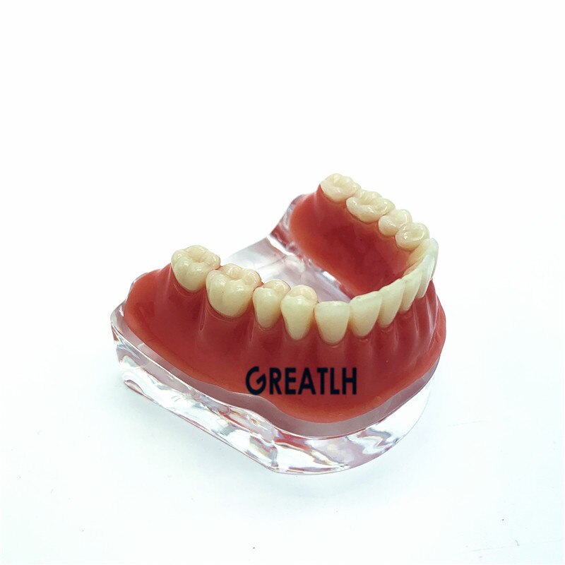 Repair teeth implant model with golden bar Denture Teeth mandibular model Dental Teaching Model