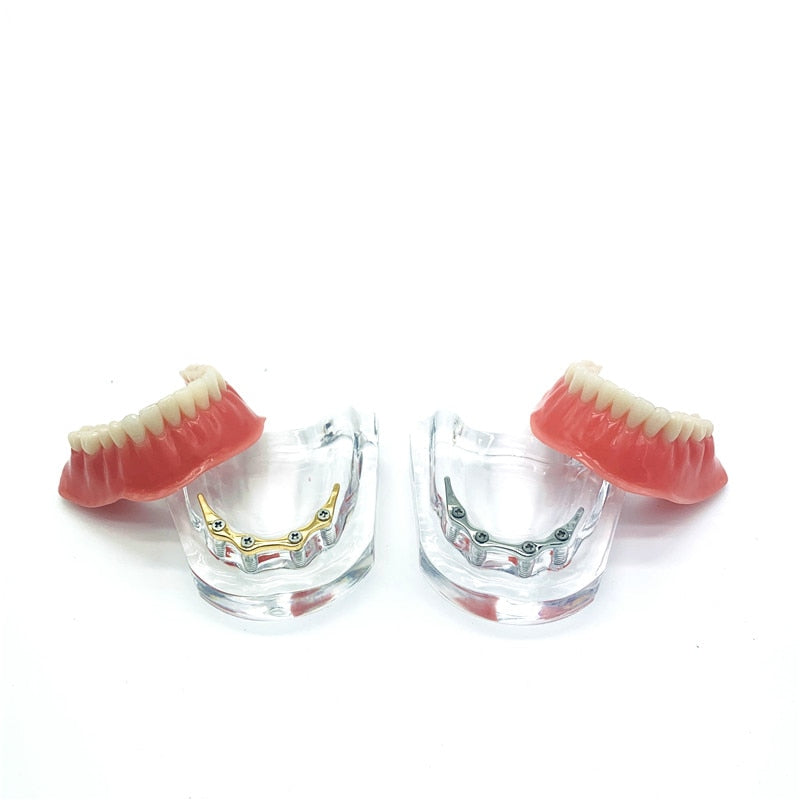 Reparieren Sie Zähne Implantatmodell mit goldenem Balken Prothesenzähne Unterkiefermodell Zahnlehrmodell