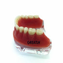Repair teeth implant model with golden bar Denture Teeth mandibular model Dental Teaching Model