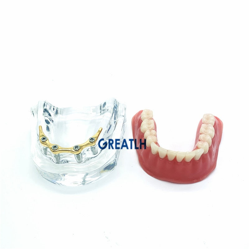 Reparieren Sie Zähne Implantatmodell mit goldenem Balken Prothesenzähne Unterkiefermodell Zahnlehrmodell